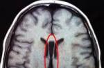 Последствия и лечение нейрофизиологической незрелости коры головного мозга у новорожденного ребенка Врожденная патология головного мозга у ребенка