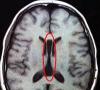 Последствия и лечение нейрофизиологической незрелости коры головного мозга у новорожденного ребенка Врожденная патология головного мозга у ребенка